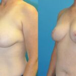 Breast Reduction #28 - Before and After