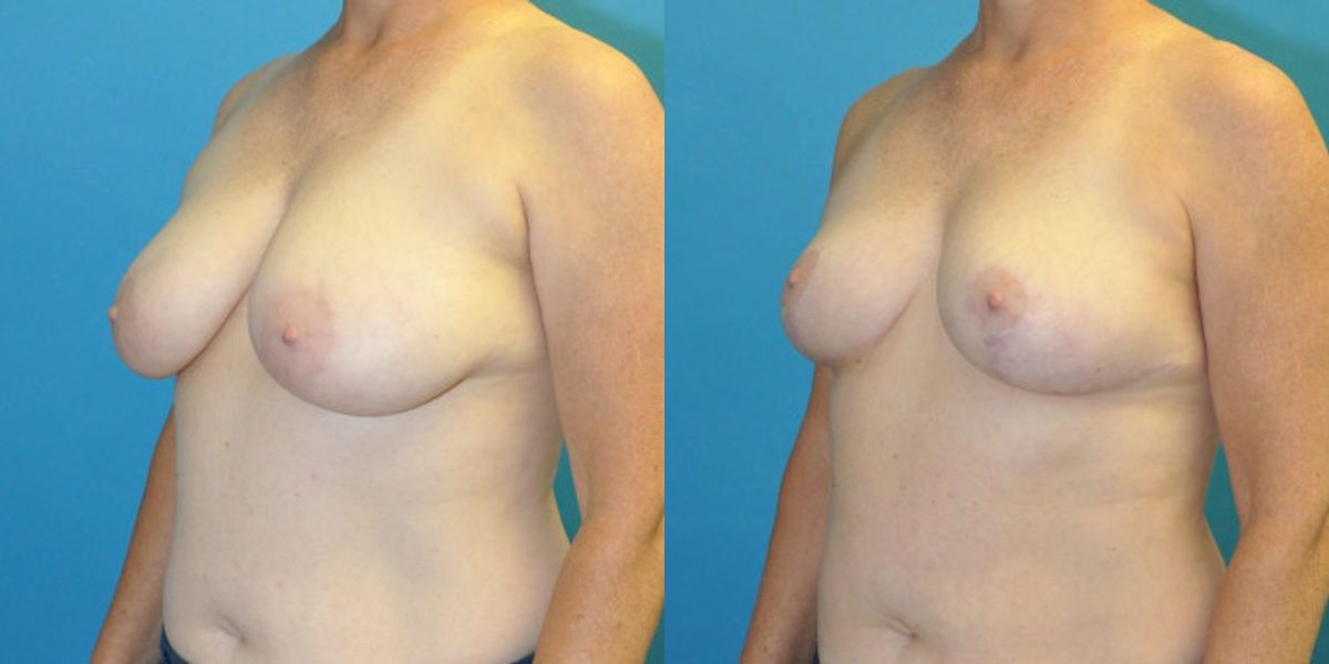 Breast Reduction #28 - Before and After