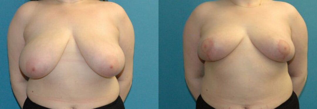 Breast Reduction #28