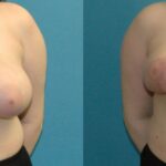Breast Reduction #29 - Before and After