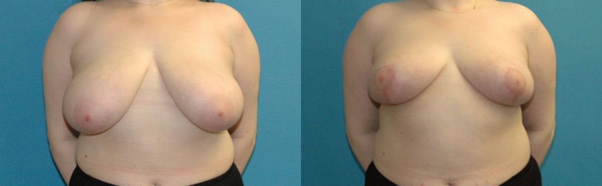 Breast Reduction #29 - Before and After