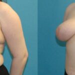 Breast Reduction #29 - Before and After