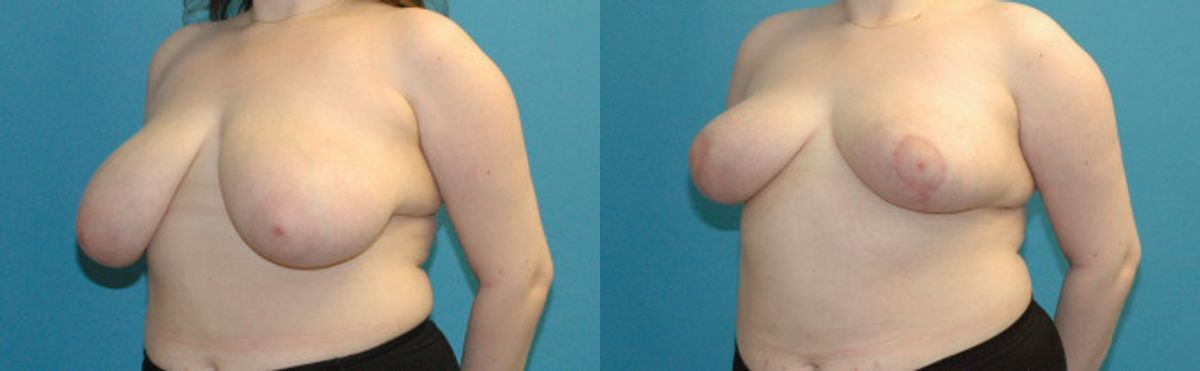 Breast Reduction #29 - Before and After