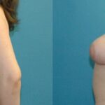 Breast Reduction #29 - Before and After