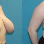 Breast Reduction #29 - Before and After