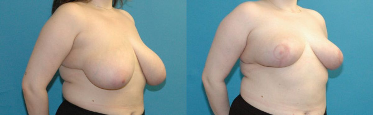 Breast Reduction #29 - Before and After