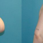 Breast Reduction #29 - Before and After