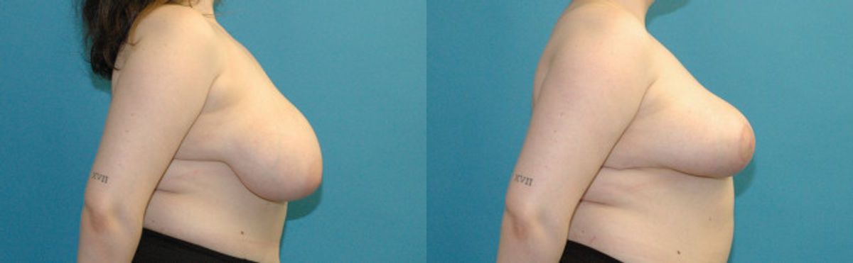 Breast Reduction #29 - Before and After