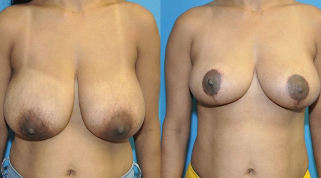 Breast Reduction #29