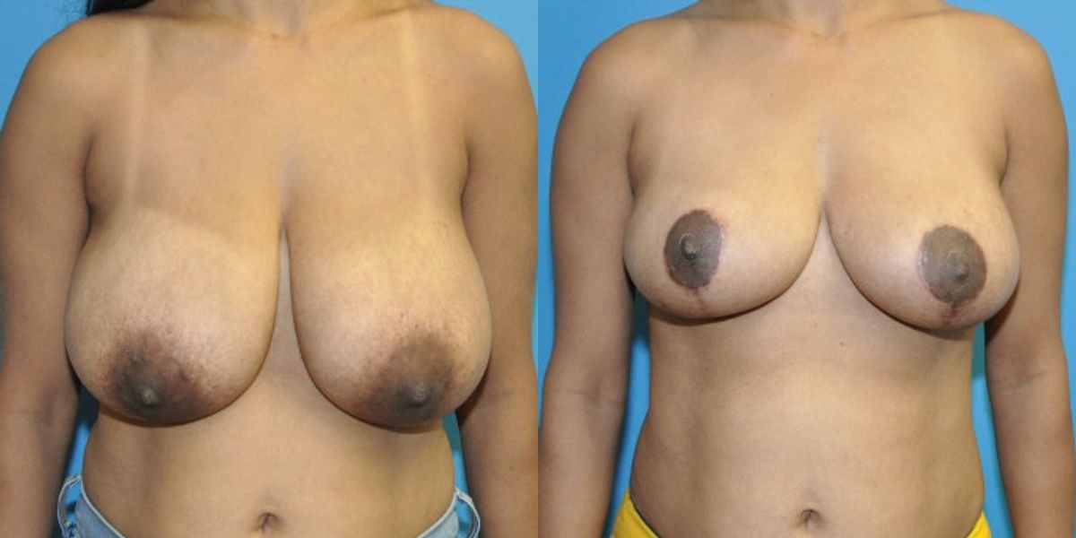 Breast Reduction #30 - Before and After
