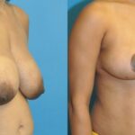 Breast Reduction #30 - Before and After