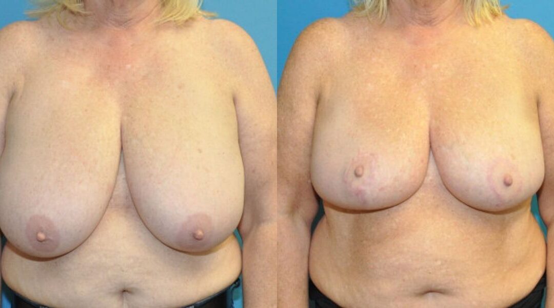 Breast Reduction #30