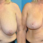 Breast Reduction #31 - Before and After