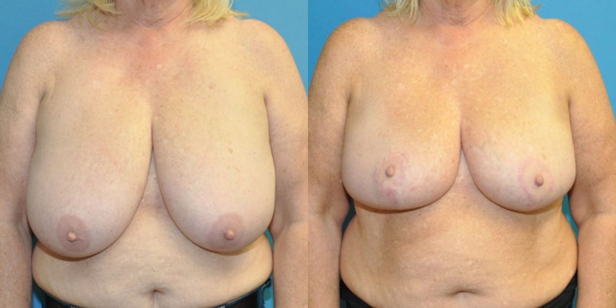 Breast Reduction #31 - Before and After