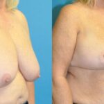 Breast Reduction #31 - Before and After
