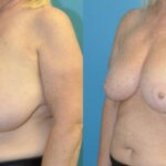 Breast Reduction #31 - Before and After
