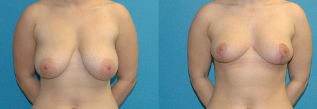 Breast Reduction #31