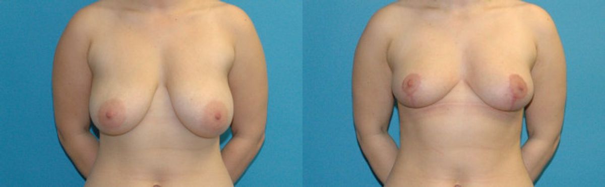 Breast Reduction #32 - Before and After