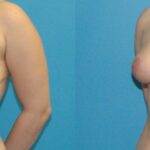 Breast Reduction #32 - Before and After