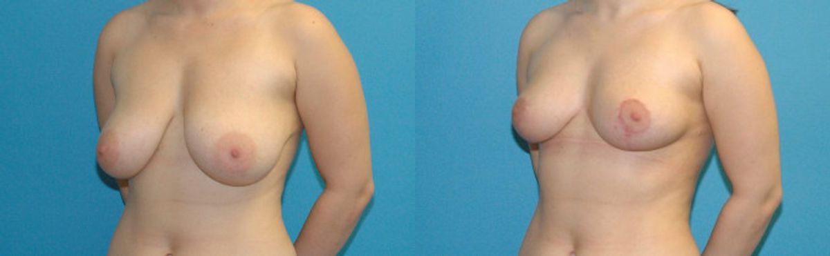 Breast Reduction #32 - Before and After