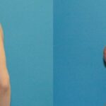 Breast Reduction #32 - Before and After