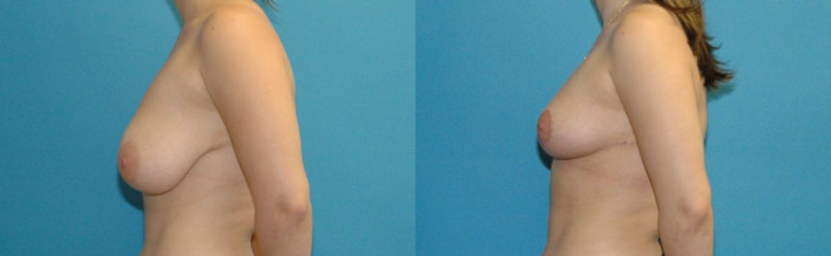 Breast Reduction #32 - Before and After