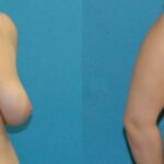 Breast Reduction #32 - Before and After