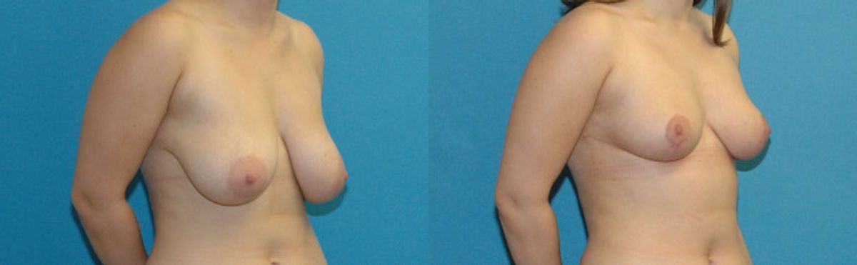 Breast Reduction #32 - Before and After