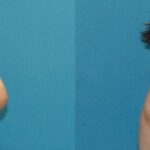 Breast Reduction #32 - Before and After