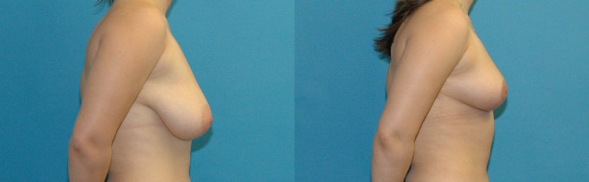 Breast Reduction #32 - Before and After