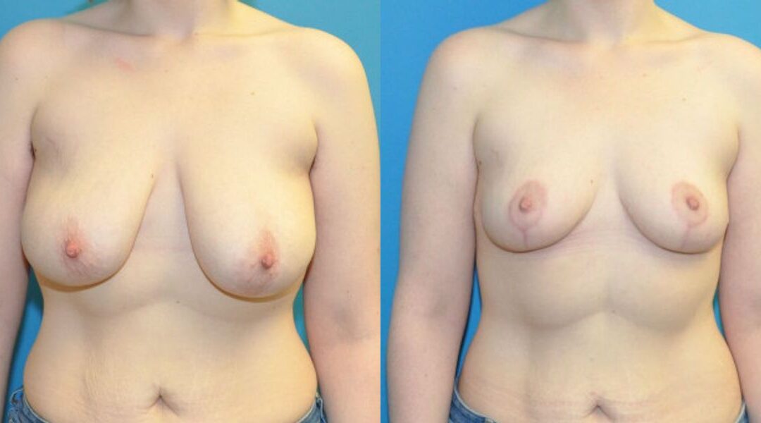 Breast Reduction #32