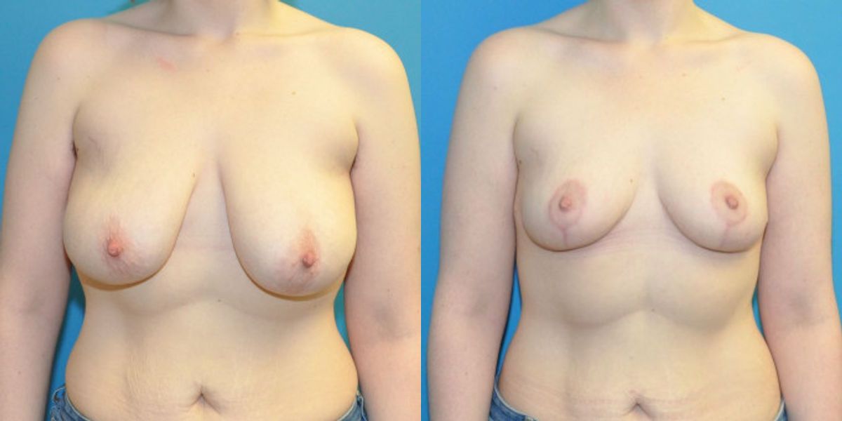 Breast Reduction #33 - Before and After