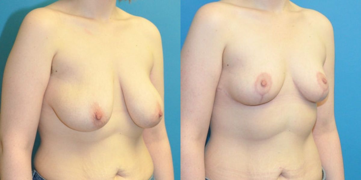 Breast Reduction #33 - Before and After