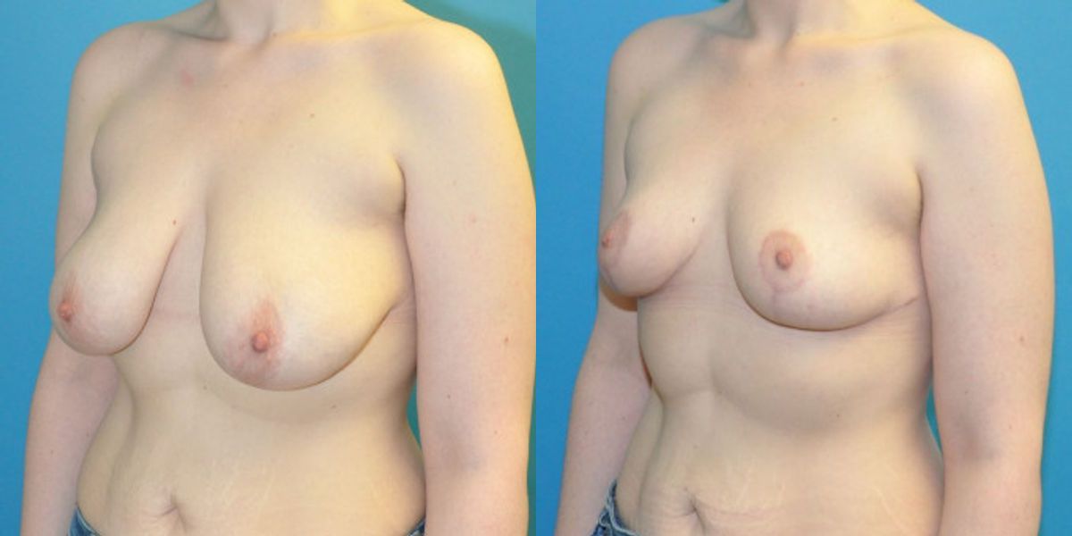 Breast Reduction #33 - Before and After