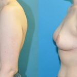 Breast Reduction #33 - Before and After