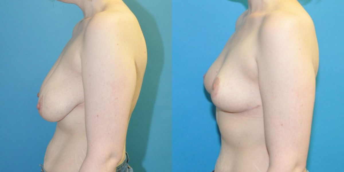 Breast Reduction #33 - Before and After