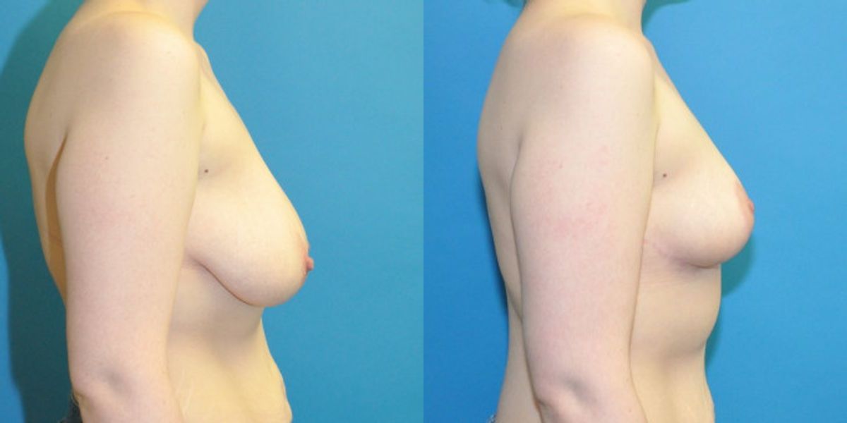 Breast Reduction #33 - Before and After