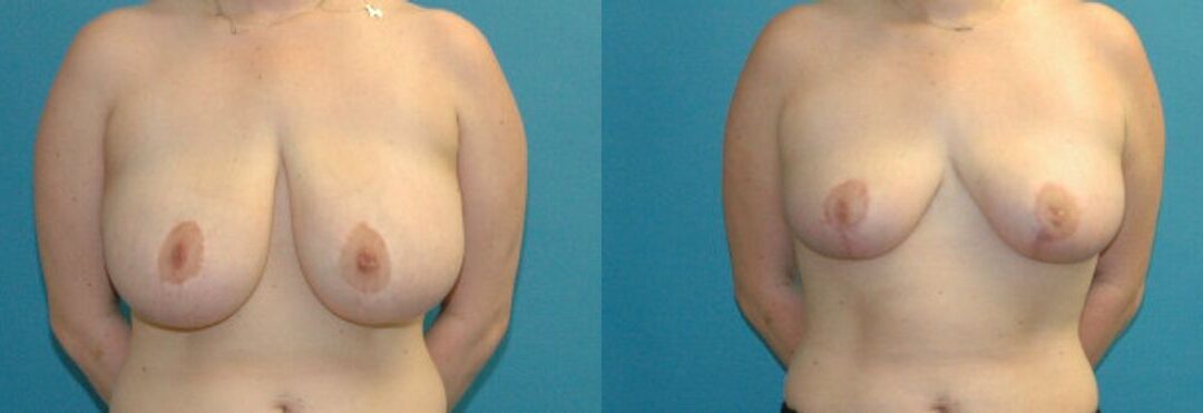 Breast Reduction #34