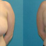Breast Reduction #34 - Before and After