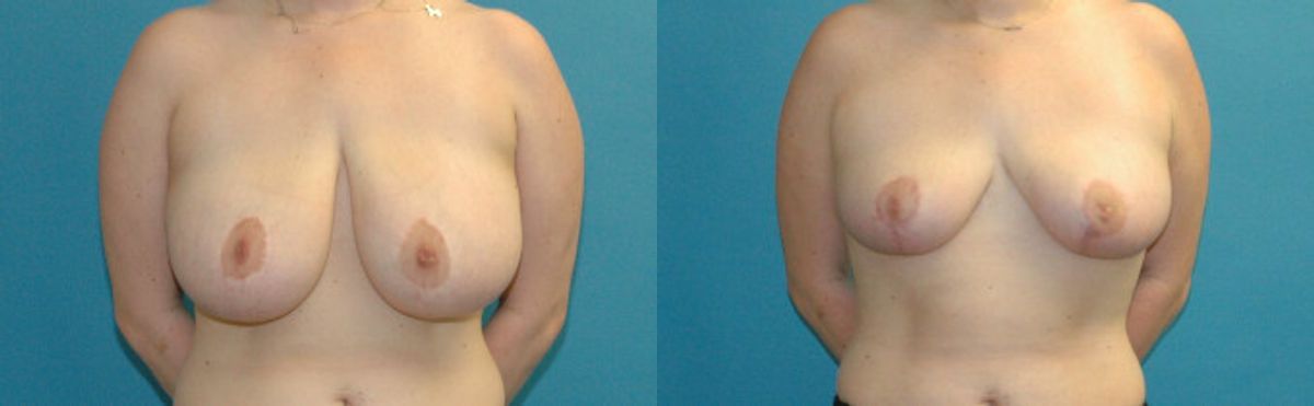 Breast Reduction #34 - Before and After
