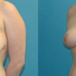 Breast Reduction #34 - Before and After