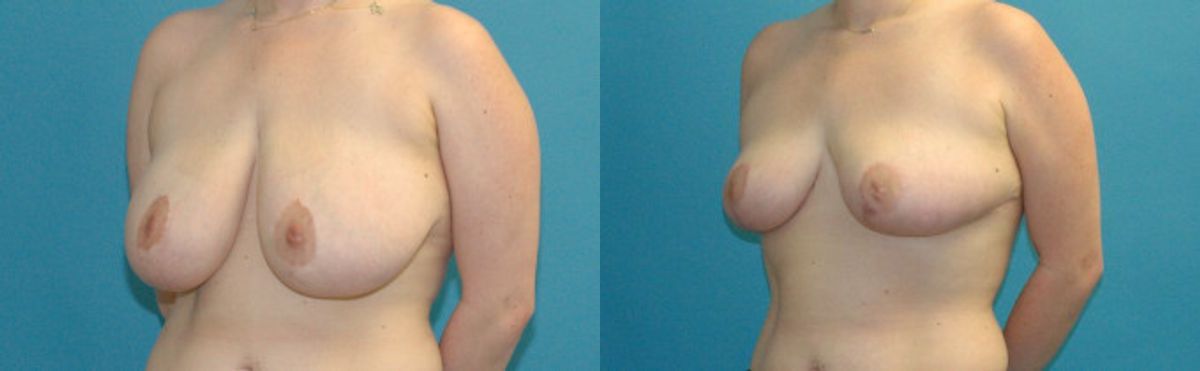Breast Reduction #34 - Before and After