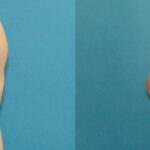 Breast Reduction #34 - Before and After