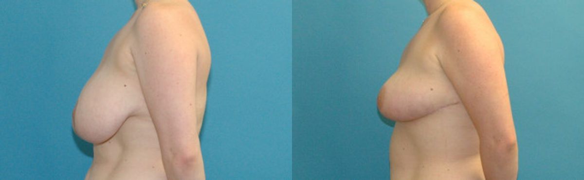 Breast Reduction #34 - Before and After