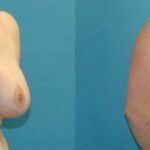 Breast Reduction #34 - Before and After