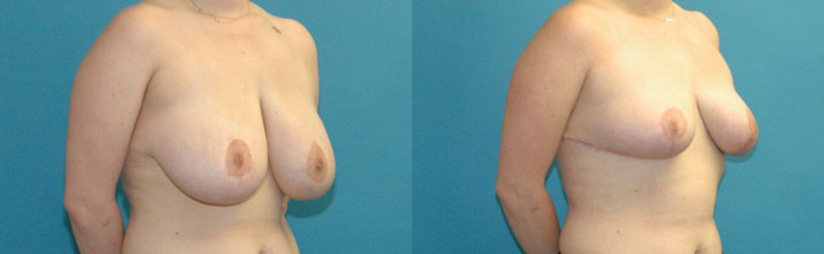 Breast Reduction #34 - Before and After