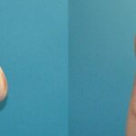 Breast Reduction #34 - Before and After