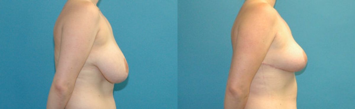 Breast Reduction #34 - Before and After