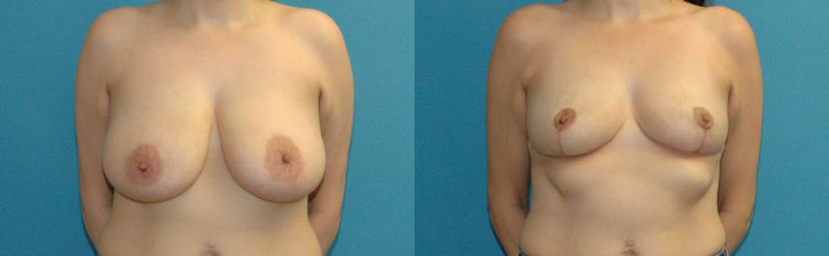 Breast Reduction #36 - Before and After