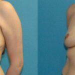 Breast Reduction #36 - Before and After